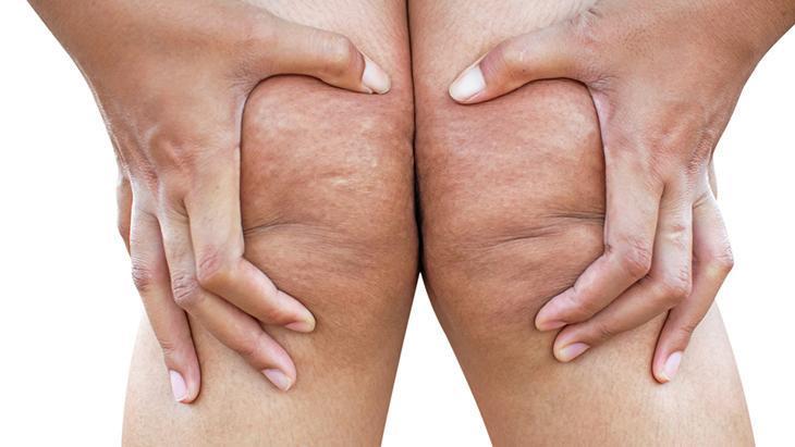 lipodem kadinlarin sessiz cigligi neden kilo veremiyorum diyenler icin cevap 1k3VgMFY.jpg